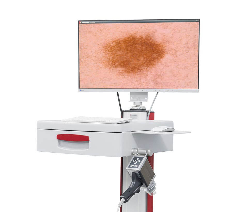 Video dermatoscope LED